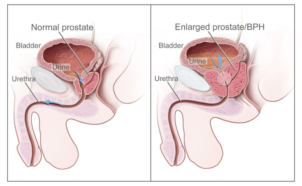 Enlarged prostate, BPH